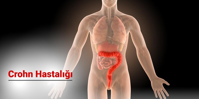 Crohn Hastalığı