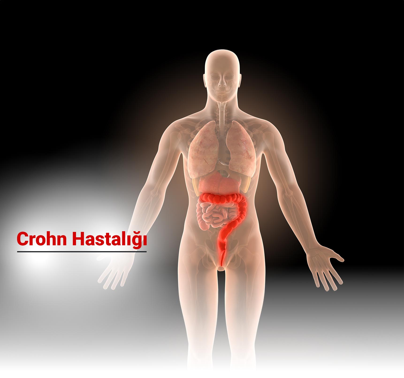 Crohn Hastalığı