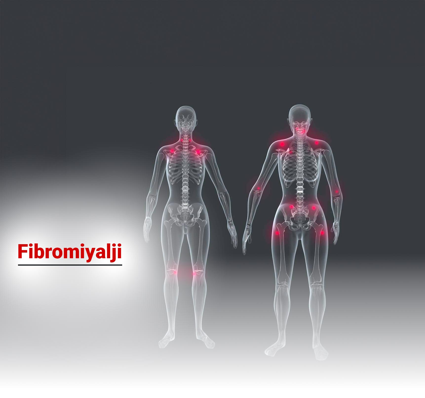 Fibromiyalji Nedir? Belirtileri Nelerdir? Tedavi Yöntemleri Nelerdir?