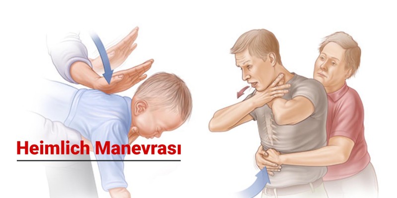 Heimlich Manevrası Nedir ve Nasıl Uygulanır?