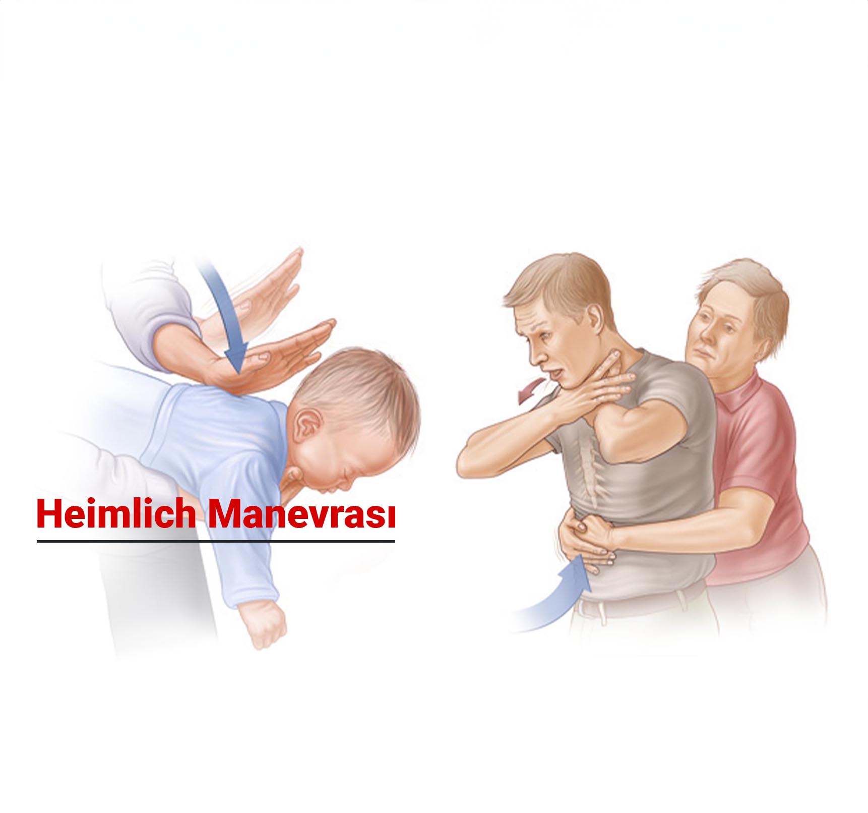 Heimlich Manevrası Nedir ve Nasıl Uygulanır?