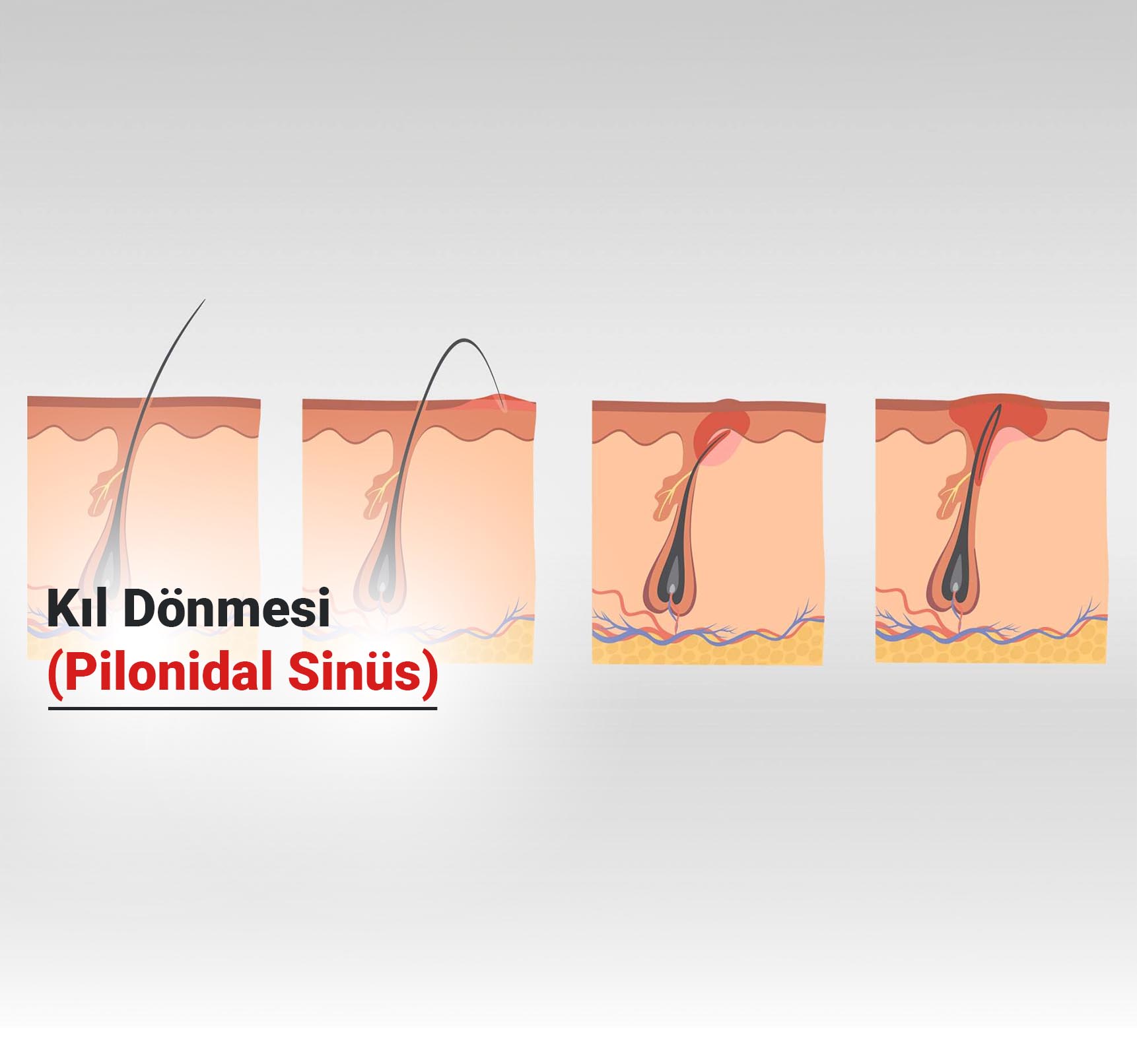 Kıl Dönmesi (Pilonidal Sinüs) Nedir?