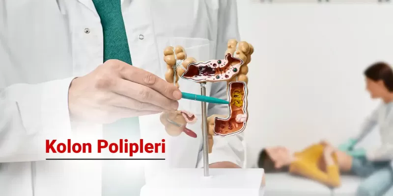 Kolon Polipleri Nedir ve Nasıl Tedavi Edilir?