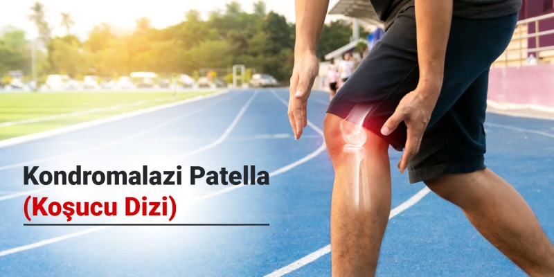 Kondromalazi Patella (Koşucu Dizi) Nedir? Belirtileri, Nedenleri ve Tedavi Yöntemleri