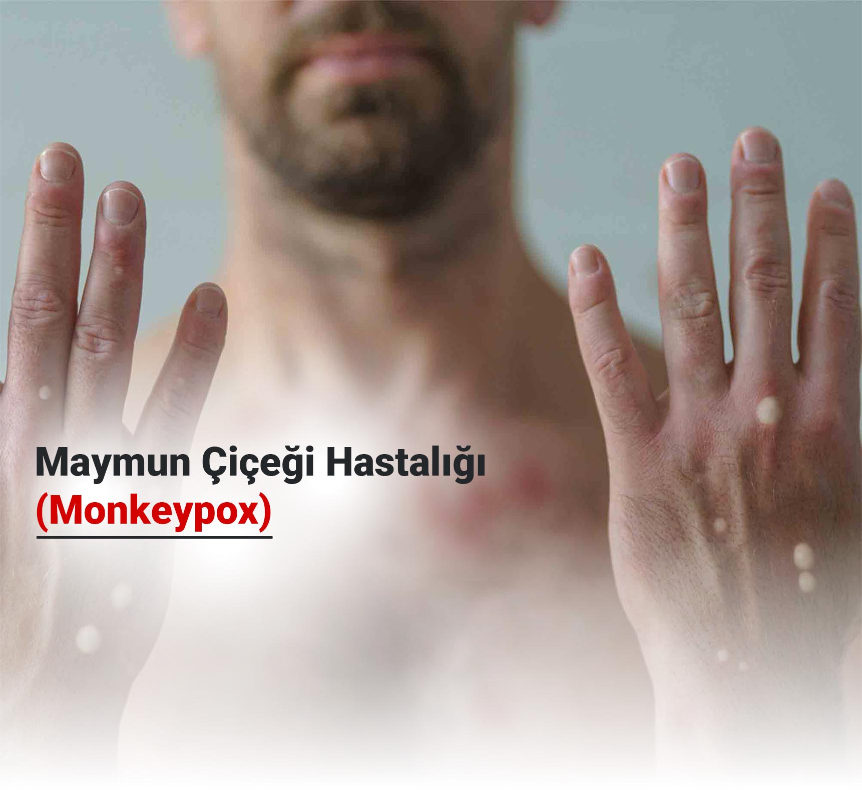 Maymun Çiçeği Hastalığı (Monkeypox) Nasıl Bulaşır? Aşısı ve Tedavi Yöntemleri