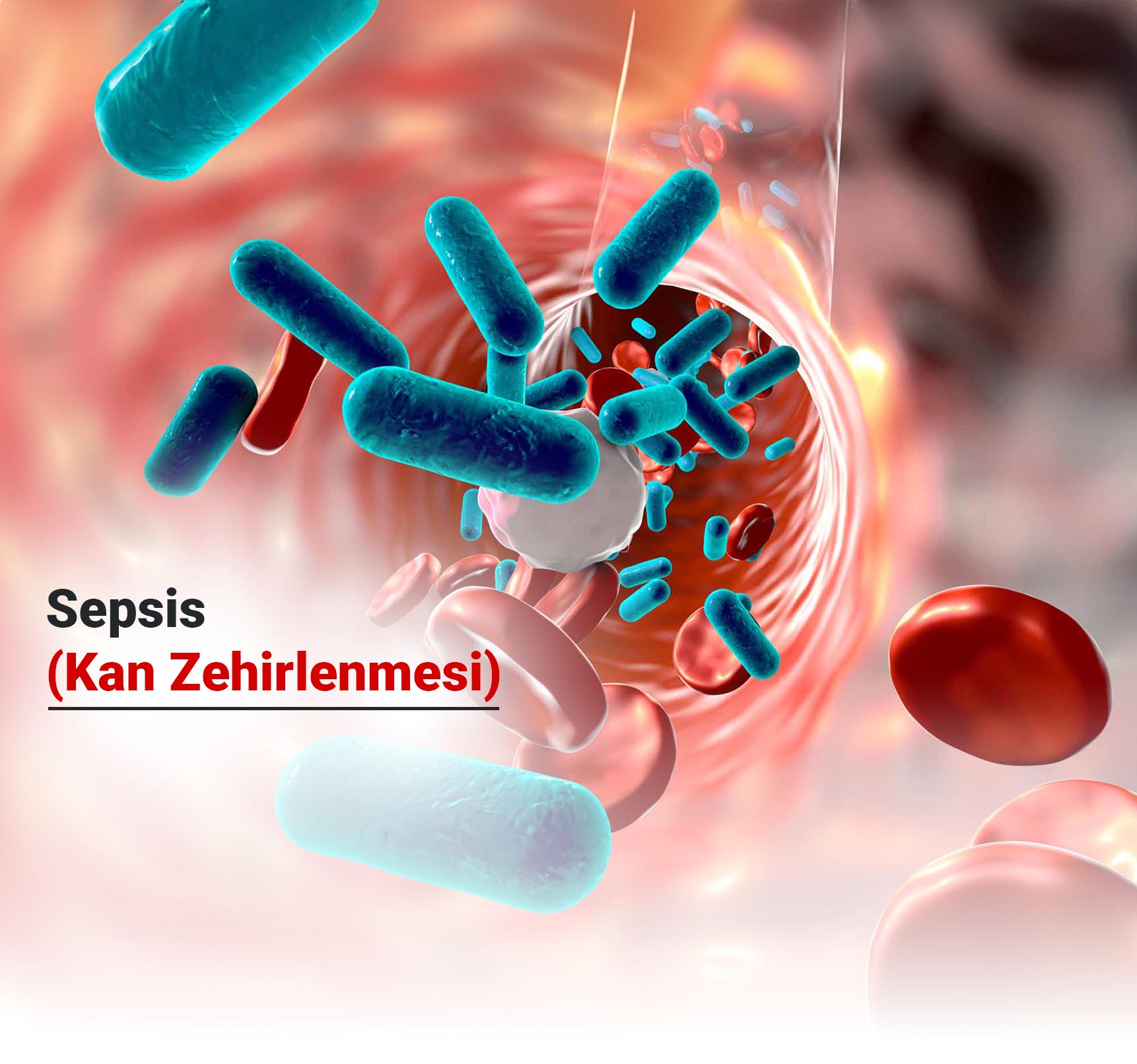 Sepsis (Kan Zehirlenmesi) Nedir?