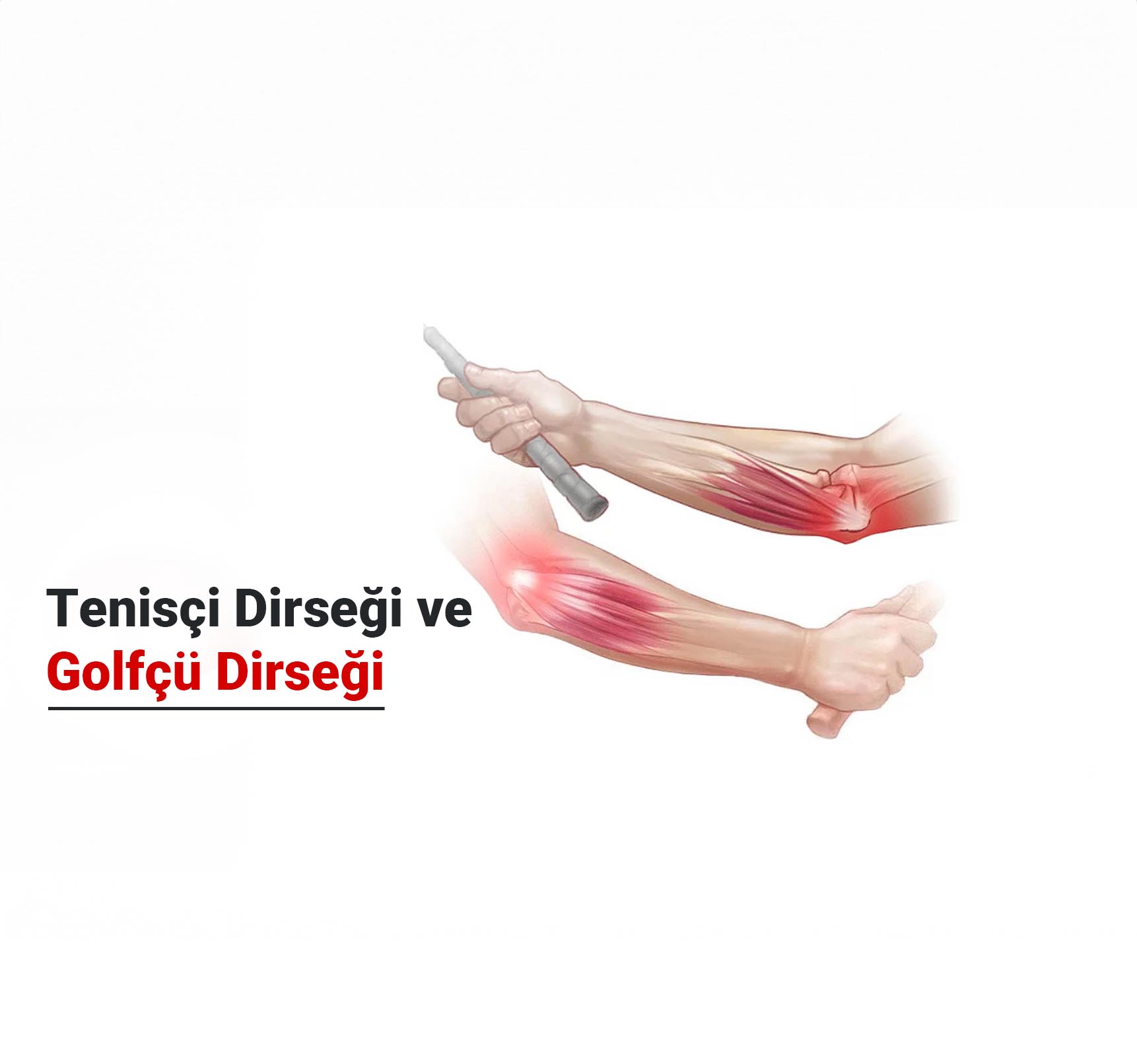 Tenisçi Dirseği ve Golfçü Dirseği