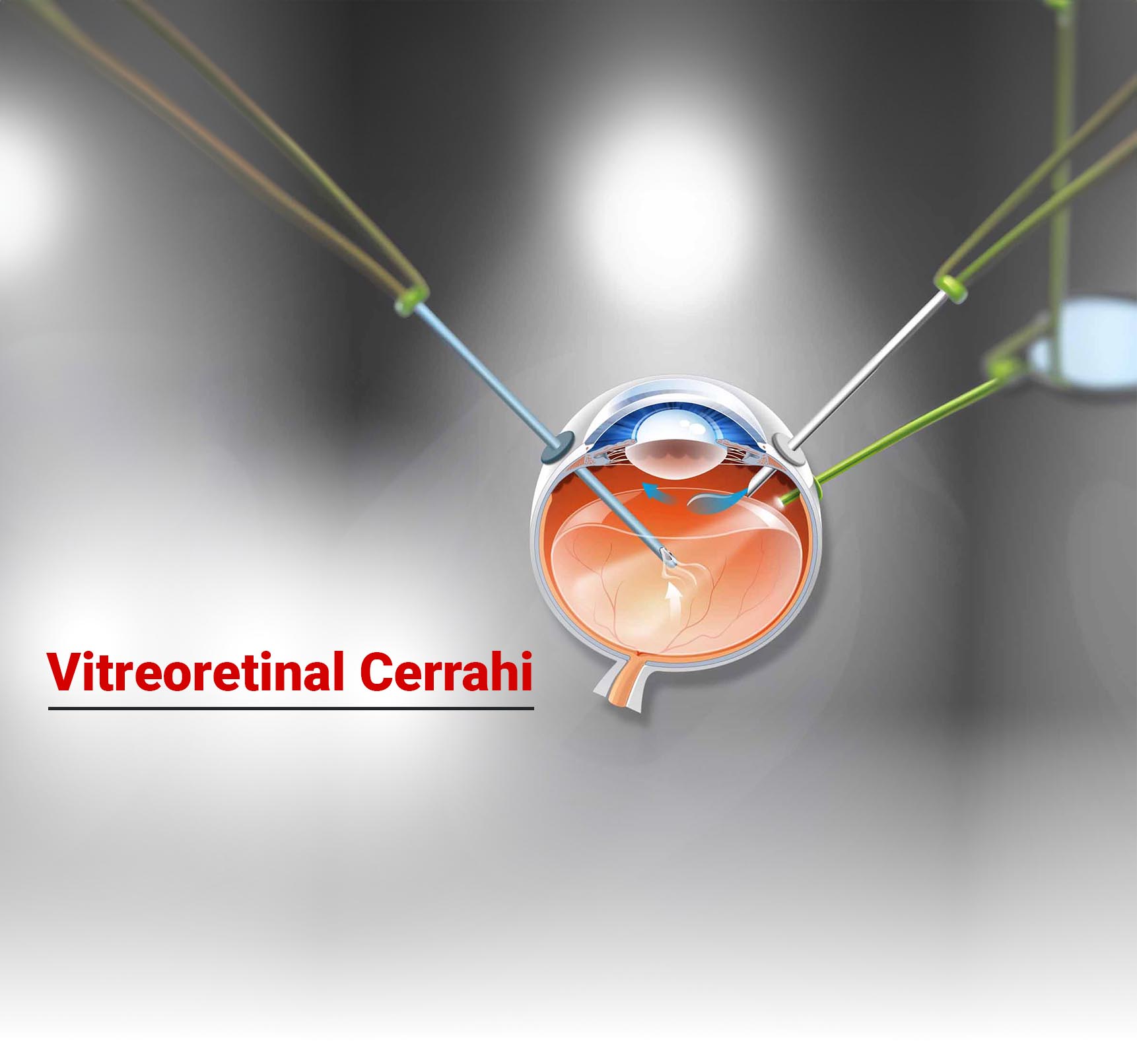 Vitreoretinal Cerrahi