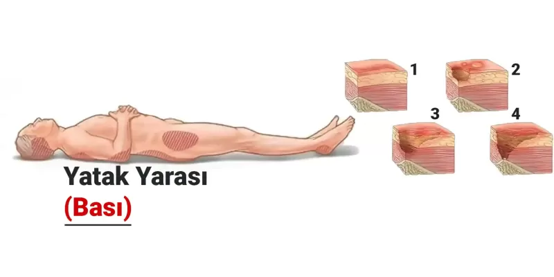 Yatak Yarası (Bası) Nedir? Neden Olur? Tedavi Yöntemleri Nelerdir?