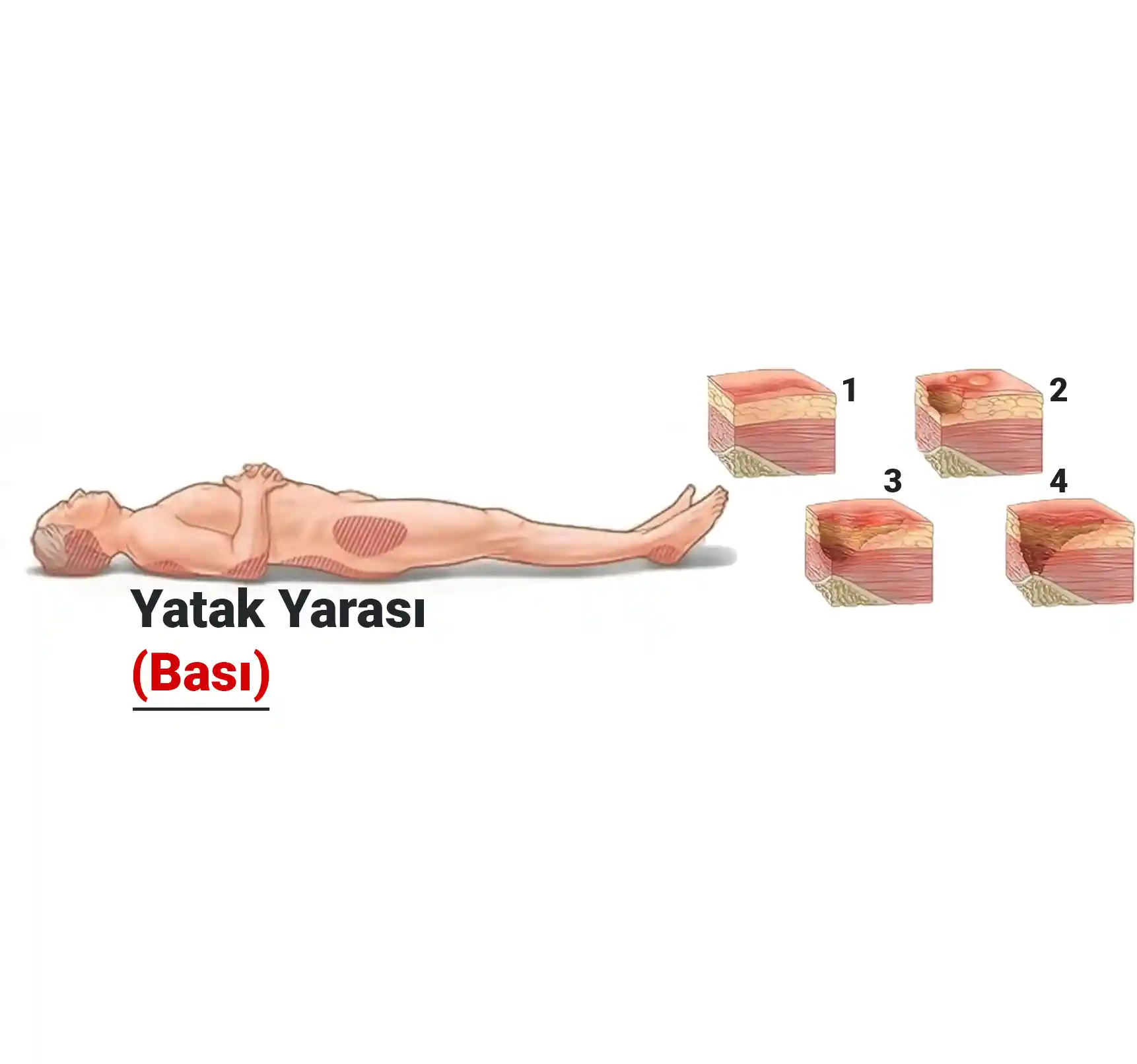 Yatak Yarası (Bası) Nedir? Neden Olur? Tedavi Yöntemleri Nelerdir?